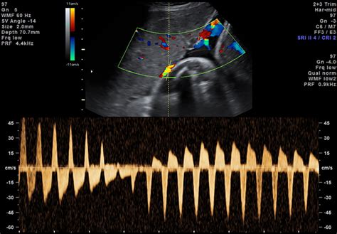 Doppler Evaluation Of Normal And Abnormal Placenta Hernandez‐andrade