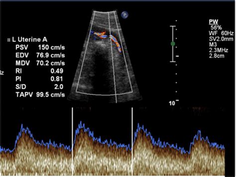 Placental Function Testing Ontario Fetal Centre