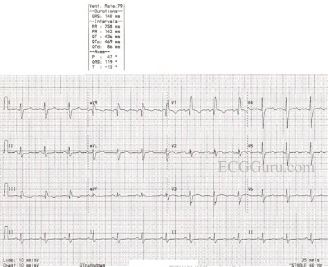 Right Bundle Branch Block | ECG Guru - Instructor Resources