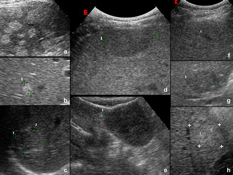 Characterization Of Focal Liver Lesions With Contrast Enhanced