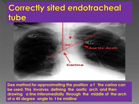 Radiological Presentation Of Pulmonary Pathology Ppt