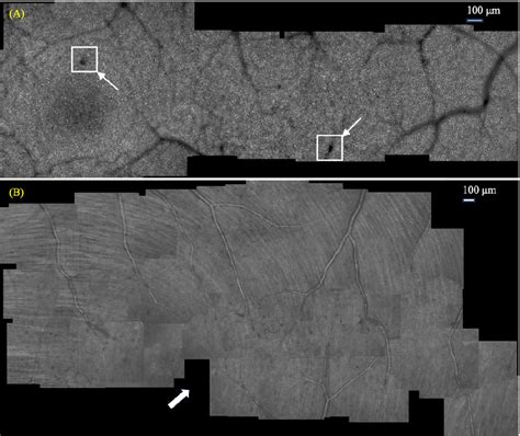 Figure 1 from Automatic montaging of adaptive optics SLO retinal images ...