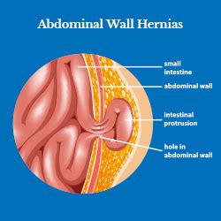 Abdominal Wall Hernia Causes Treatment And Recovery Guide