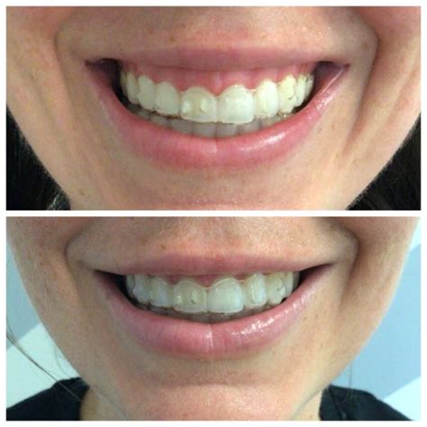 Treating A Gummy Smile With Botox The Daily Glimmer