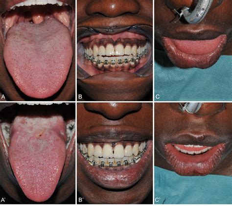 New Surgical Method Of Tongue Reduction For Macroglossia Technical