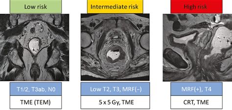 Restaging Of Rectal Cancer After Crt With Mri A Transverse