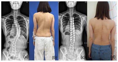 JCM Free Full Text Novel Surgical Technique For Adolescent