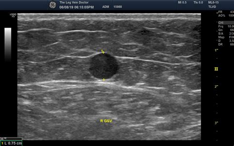 Incompetent Saphenous Veins Are The Most Frequent Cause Of Severe