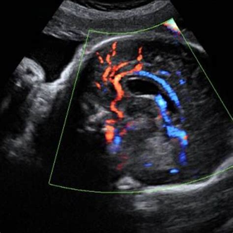 Third Trimester Ultrasound Pictures