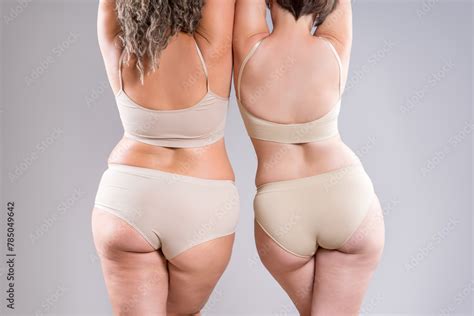 Two Overweight Women With Cellulitis Fat Flabby Back Hips And