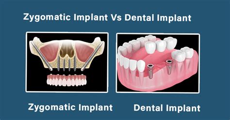 Now Get Zygomatic Implants In One Day Royal Dental Clinics Blog