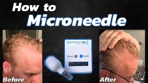 How To Microneedle For Hair Loss Using The Derminator 2 Youtube