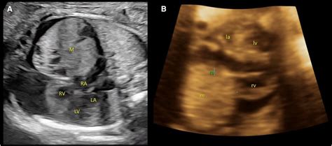 Frontiers A Giant Teratoma In The Anterior Mediastinum Found