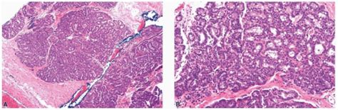 Fibroepithelial Neoplasms Basicmedical Key