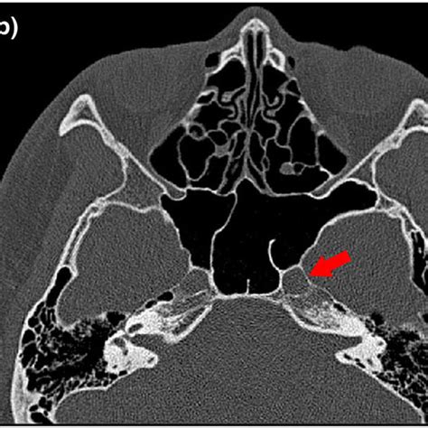 Sphenoid Bone Extracted View From Above Download Scientific Diagram