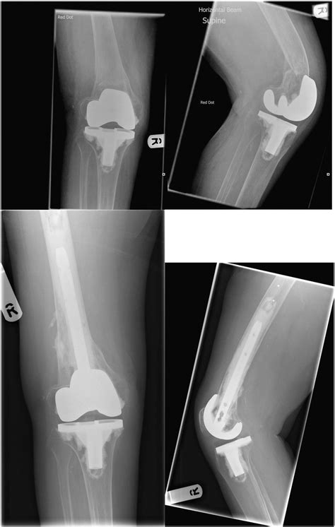 Periprosthetic Fractures In The Distal Femur Following Total Knee Replacement A Review And