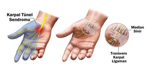 Karpal T Nel Sendromu Nedir Nas L Tedavi Edilir Prof Dr Levent