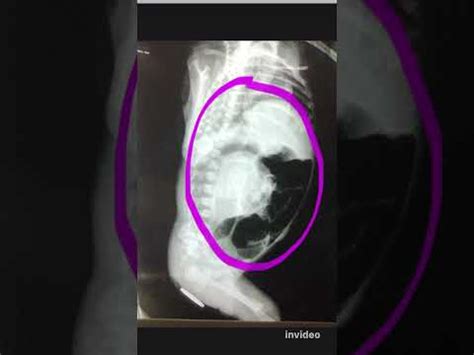 Anotectal Malformation Anal Atresia Xray Of Newborn YouTube