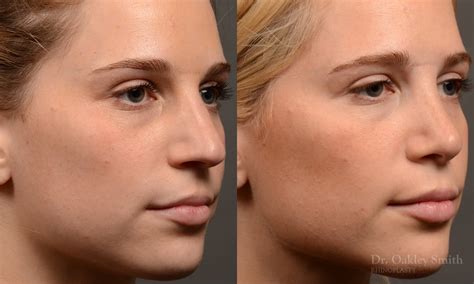 466b Rhinoplasty Dr Oakley Smith Toronto Top Surgeon Nose Job