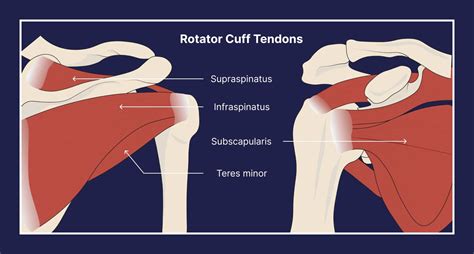 Rotator Cuff Tendinitis Everything You Need To Know