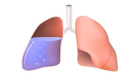 Edema Pulmonar O Que Quais Os Sintomas E Como Tratar Noticia Ao