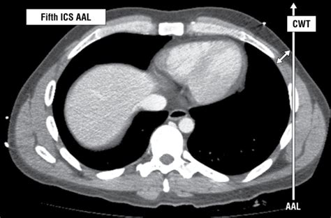 Radiologic Evaluation Of Alternative Sites For Needle Decompression Of