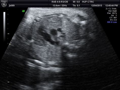 Fetal Echocardiographic 3 Vessel View Highly Sensitive