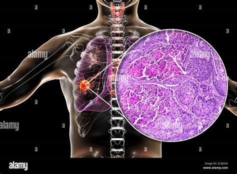 Lung Cancer Cell Diagram