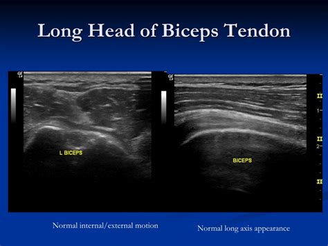 Ppt Intro To Musculoskeletal Ultrasound Of The Shoulder Powerpoint