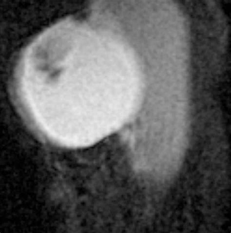 Mr Imaging In The Evaluation Of Cystic Appearing Soft Tissue Masses Of