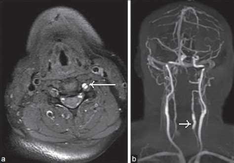 Vertebral Artery Dissection Mri