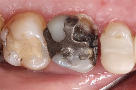 Proc And Cons Of Amalgam Fillings — Clean Teeth Dental