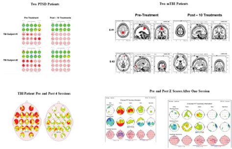 New Advances In Electrical Neuroimaging Brain Networks And