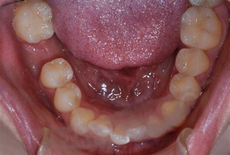 Orthopantomogram Showing A Well Defined Unilocular Radiolucency With