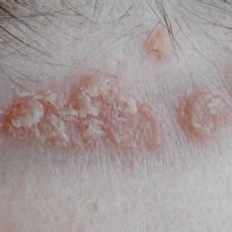 Genetic Factors Affecting Psoriasis. | Psoriasis, Skin health, Heredity