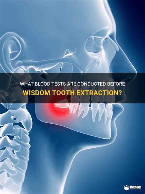 What Blood Tests Are Conducted Before Wisdom Tooth Extraction Medshun