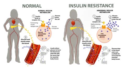 Managing Blood Sugar And Insulin Resistance Morgan Compounding