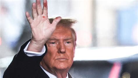 Rănile misterioase de pe mâna lui Trump Un expert în dermatologie a