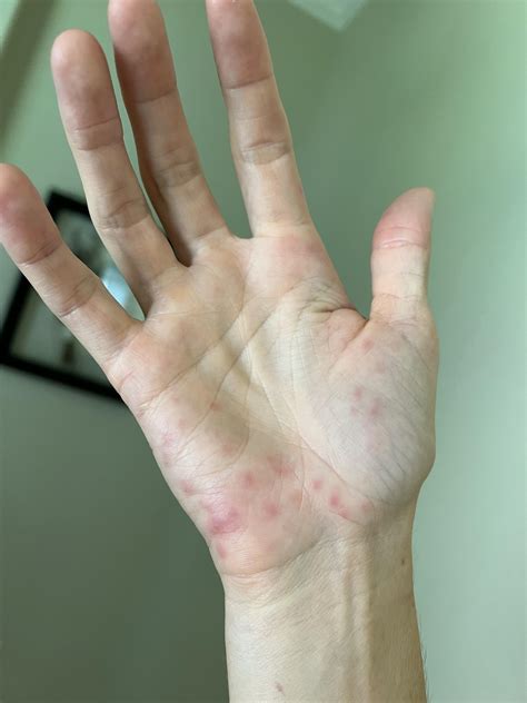 Does Anybody Else Get A Rash Like This On Their Hands Seems To Flare After Sun Exposure R Lupus