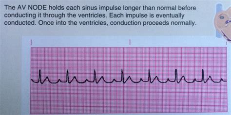 Ekg Strips Pct Test Flashcards Quizlet