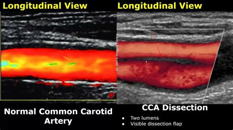 Carotid Artery Color/Spectral Doppler Ultrasound Normal Vs Abnormal ...