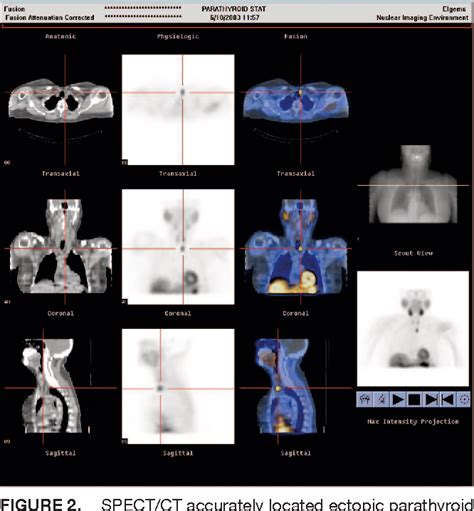 Pdf The Value Of Mtc Sestamibi Spect Ct Over Conventional Spect In