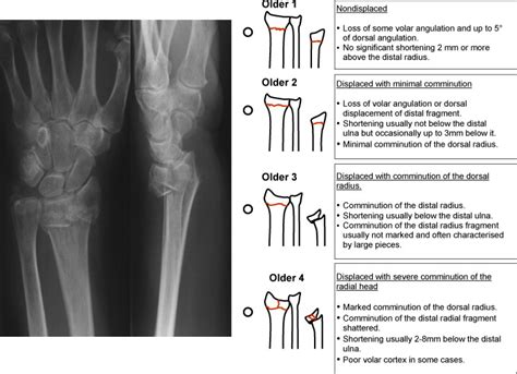 Colles Fracture Classification