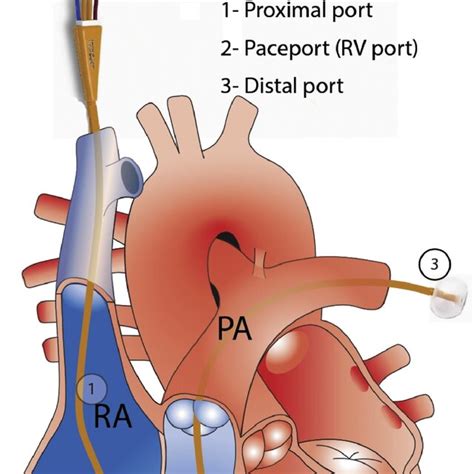 Pulmonary Artery Catheter