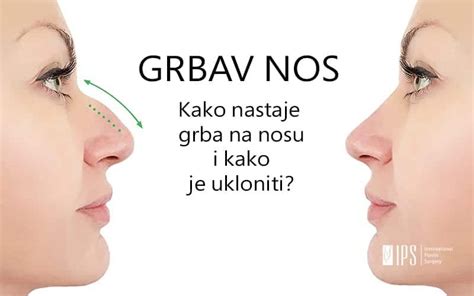 Grbav Nos Kako Nastaje Grba Na Nosu I Kako Je Ukloniti Ips