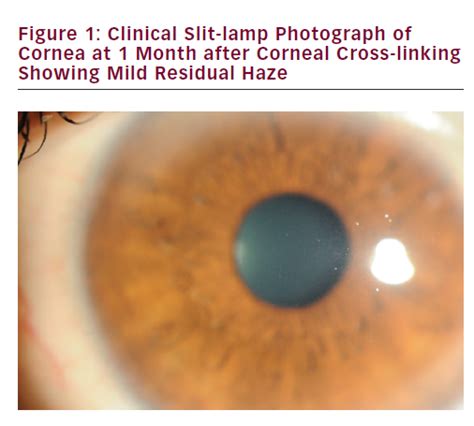 Corneal Collagen Cross Linking For Keratoconus Touchophthalmology