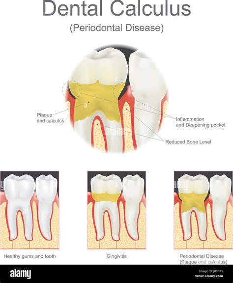 Dental calculus is the calcified plaque, or tartar, that is removed ...