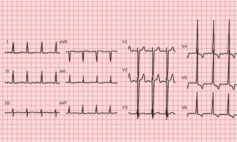 Left Ventricular Hypertrophy ECG Findings