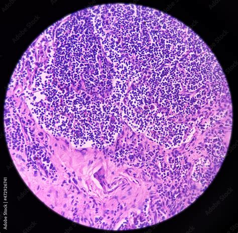 Lymph Angioma Photomicrograph Of Lymphangioma Cystic Hygroma Or