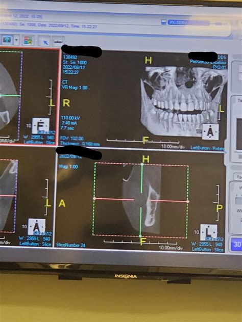 Wisdom Teeth Too Close To My Nerves What Do Yall Think 2d Xray Rwisdomteeth